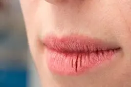  چطور ترک لب را درمان کنیم؟