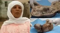 زنی که سنگ زایید! | زایمانی عجیب بعد از چهل سال!+تصاویر نوزاد عجیب 