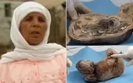 زنی که سنگ زایید! | زایمانی عجیب بعد از چهل سال!+تصاویر نوزاد عجیب 