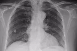 آنچه لازم است از «سل» بدانیم|از مسری بودن تا درمان بیماری 