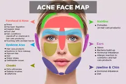 جوش زدن در هر قسمت از صورت نشانه چیست؟ | معنی جوش در قسمت های مختلف صورت