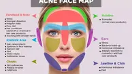 جوش زدن در هر قسمت از صورت نشانه چیست؟ | معنی جوش در قسمت های مختلف صورت