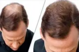 چه ویتامین هایی برای رشد بهتر مو موثر است؟ 