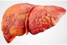 چجوری مبتلا به کبد چرب نشویم؟ | راه حل پیشگیری