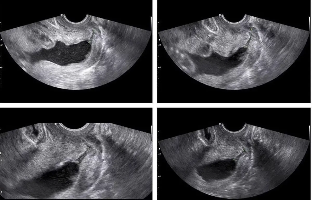 همه چیز درباره سونوگرافی آنومالی اسکن بارداری و سلامت جنین