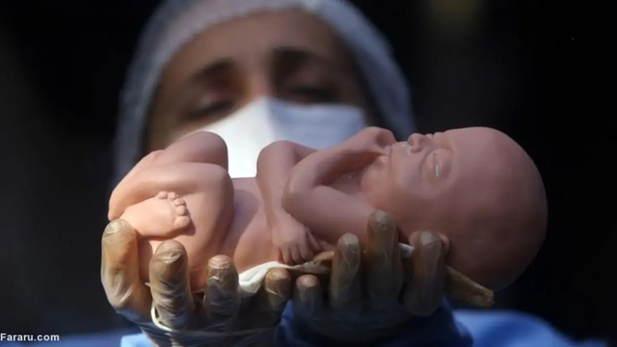 آمار‌های تکان‌دهنده سقط جنین در ایران